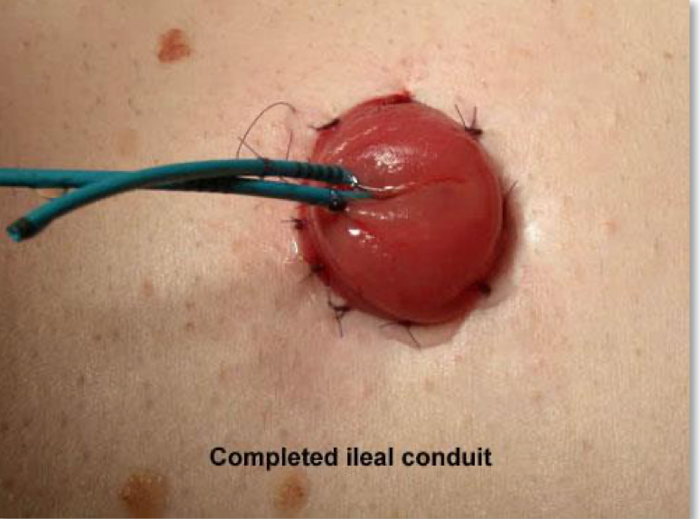 Completed ileal conduit stoma